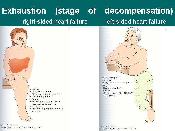 Exhaustion (stage right-sided heart failure of decompensation) left-sided heart failure 