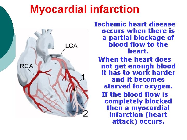 Myocardial infarction Ischemic heart disease occurs when there is a partial blockage of blood