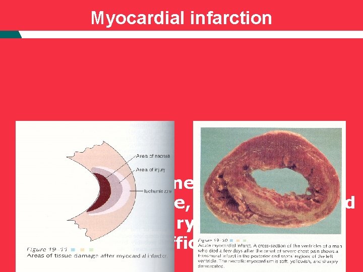 Myocardial infarction Ischaemical necrosis of the myocardial tissue, which is resulted from coronary blood