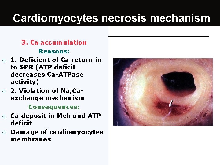Cardiomyocytes necrosis mechanism ¡ ¡ 3. Са accumulation Reasons: 1. Deficient of Ca return