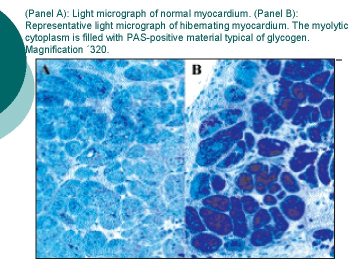 (Panel A): Light micrograph of normal myocardium. (Panel B): Representative light micrograph of hibernating