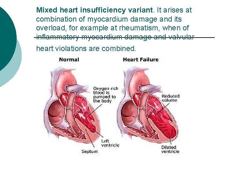 Mixed heart insufficiency variant. It arises at combination of myocardium damage and its overload,