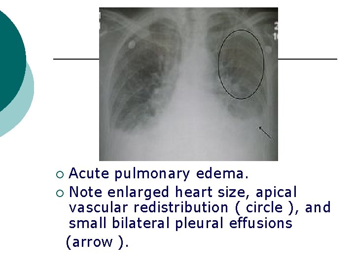 Acute pulmonary edema. ¡ Note enlarged heart size, apical vascular redistribution ( circle ),