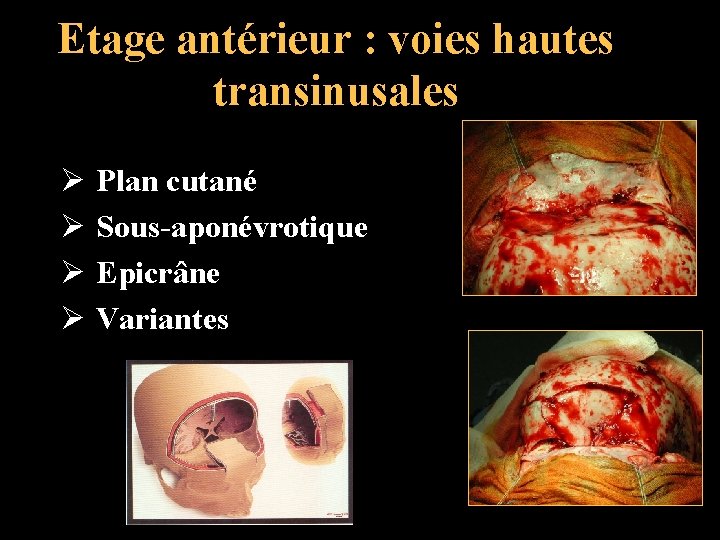 Etage antérieur : voies hautes transinusales Ø Plan cutané Ø Sous-aponévrotique Ø Epicrâne Ø