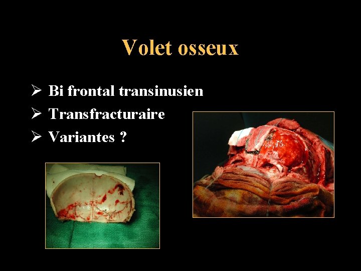 Volet osseux Ø Bi frontal transinusien Ø Transfracturaire Ø Variantes ? 