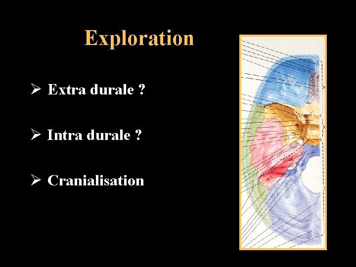 Exploration Ø Extra durale ? Ø Intra durale ? Ø Cranialisation 