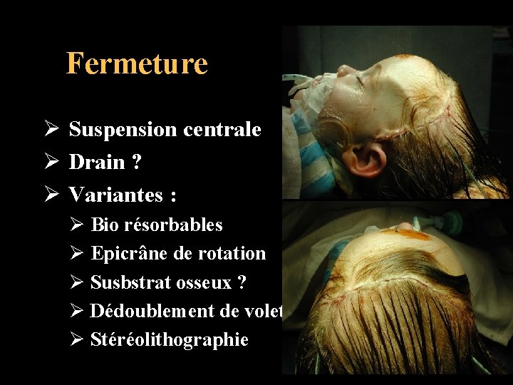 Fermeture Ø Suspension centrale Ø Drain ? Ø Variantes : Ø Bio résorbables Ø