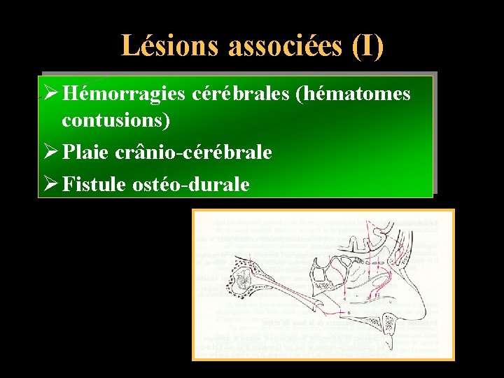 Lésions associées (I) Ø Hémorragies cérébrales (hématomes contusions) Ø Plaie crânio-cérébrale Ø Fistule ostéo-durale