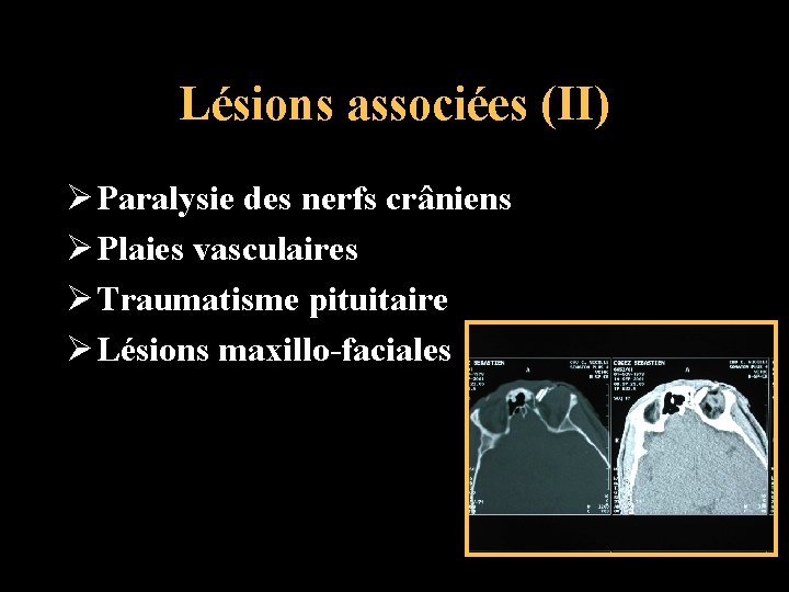 Lésions associées (II) Ø Paralysie des nerfs crâniens Ø Plaies vasculaires Ø Traumatisme pituitaire