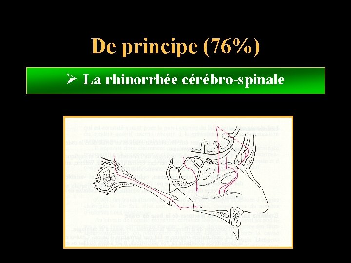 De principe (76%) Ø La rhinorrhée cérébro-spinale 