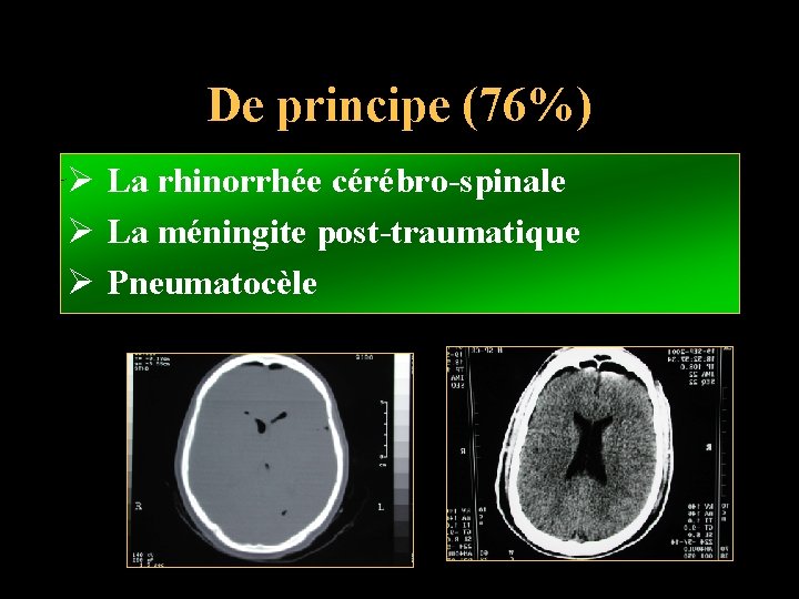 De principe (76%) Ø La rhinorrhée cérébro-spinale Ø La méningite post-traumatique Ø Pneumatocèle 