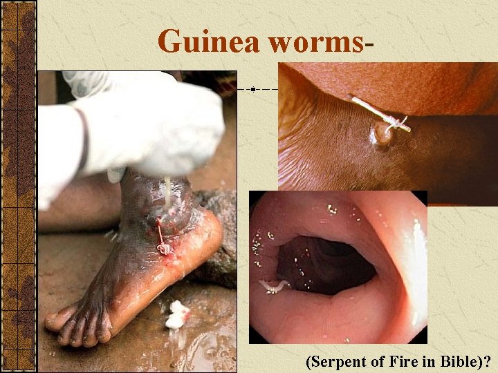 Guinea worms- (Serpent of Fire in Bible)? 