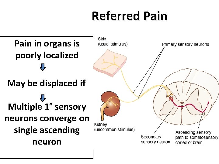 Referred Pain in organs is poorly localized May be displaced if Multiple 1° sensory