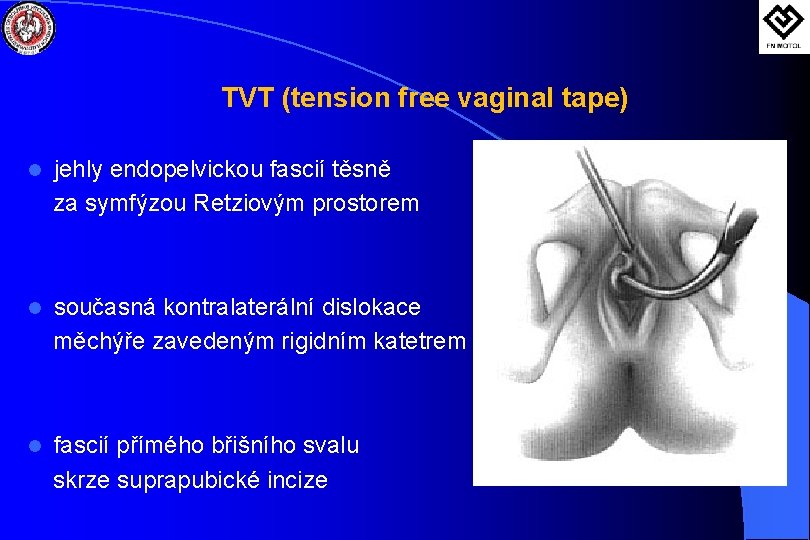 TVT (tension free vaginal tape) l jehly endopelvickou fascií těsně za symfýzou Retziovým prostorem