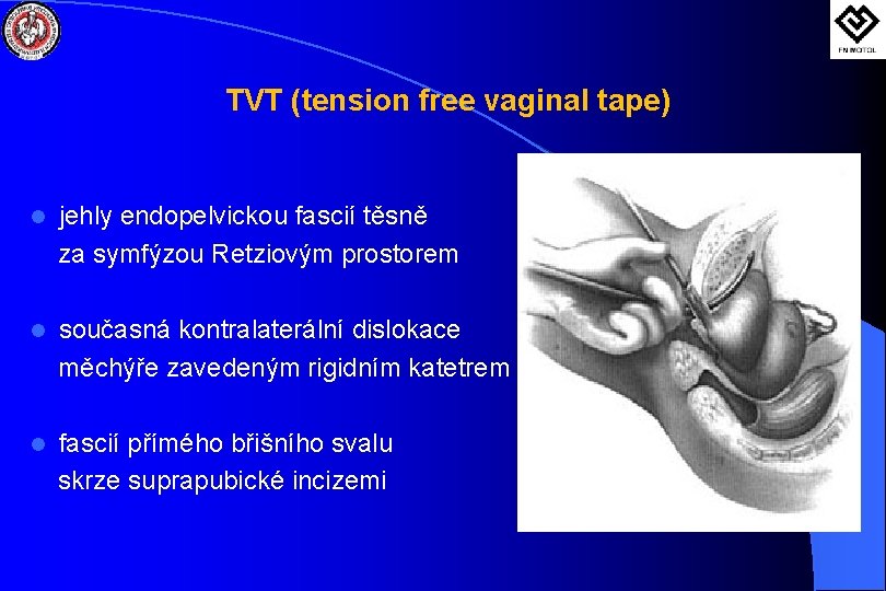 TVT (tension free vaginal tape) l jehly endopelvickou fascií těsně za symfýzou Retziovým prostorem