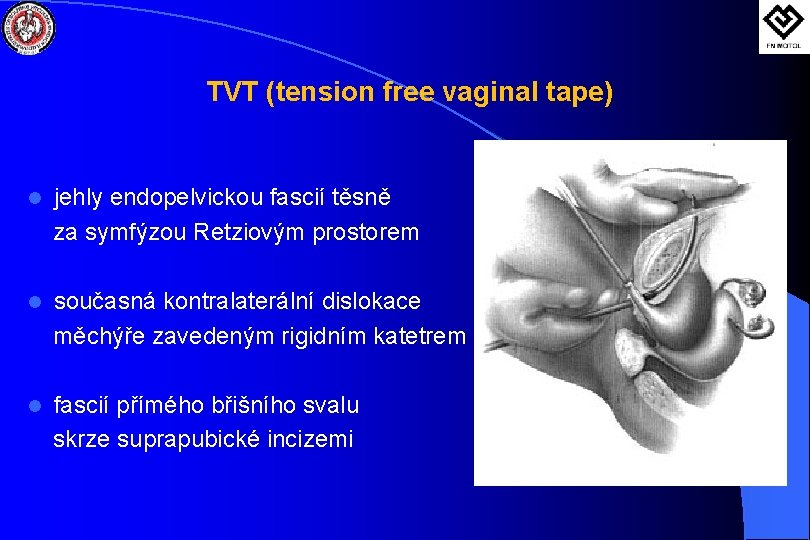 TVT (tension free vaginal tape) l jehly endopelvickou fascií těsně za symfýzou Retziovým prostorem
