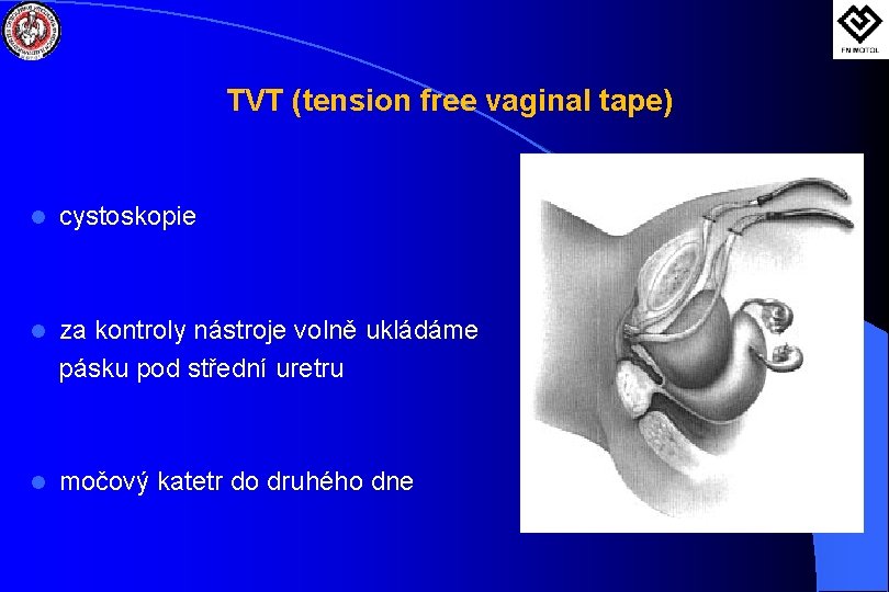 TVT (tension free vaginal tape) l cystoskopie l za kontroly nástroje volně ukládáme pásku
