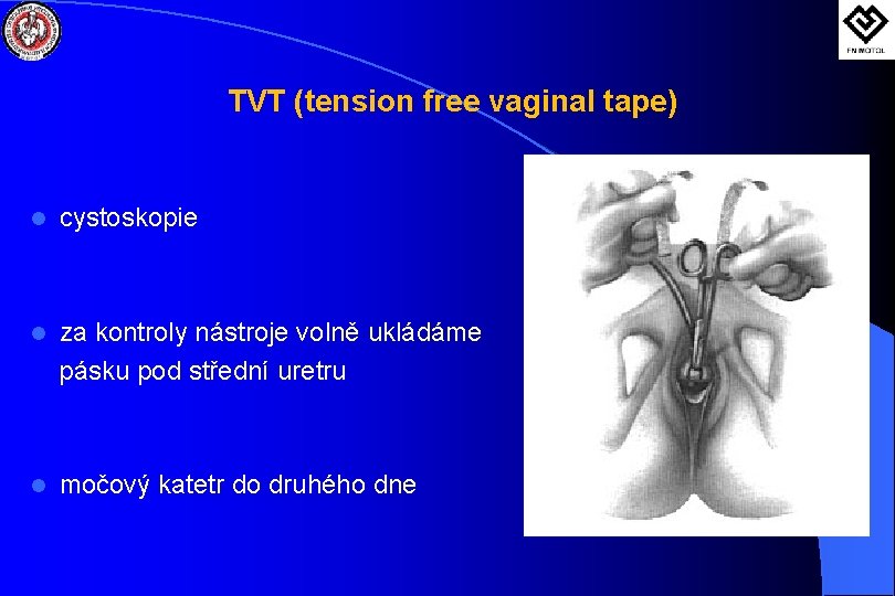 TVT (tension free vaginal tape) l cystoskopie l za kontroly nástroje volně ukládáme pásku