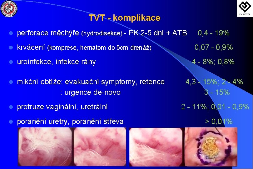 TVT - komplikace l perforace měchýře (hydrodisekce) - PK 2 -5 dní + ATB
