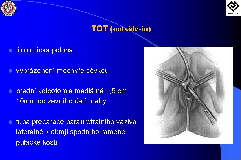 TOT (outside-in) l litotomická poloha l vyprázdnění měchýře cévkou l přední kolpotomie mediálně 1,