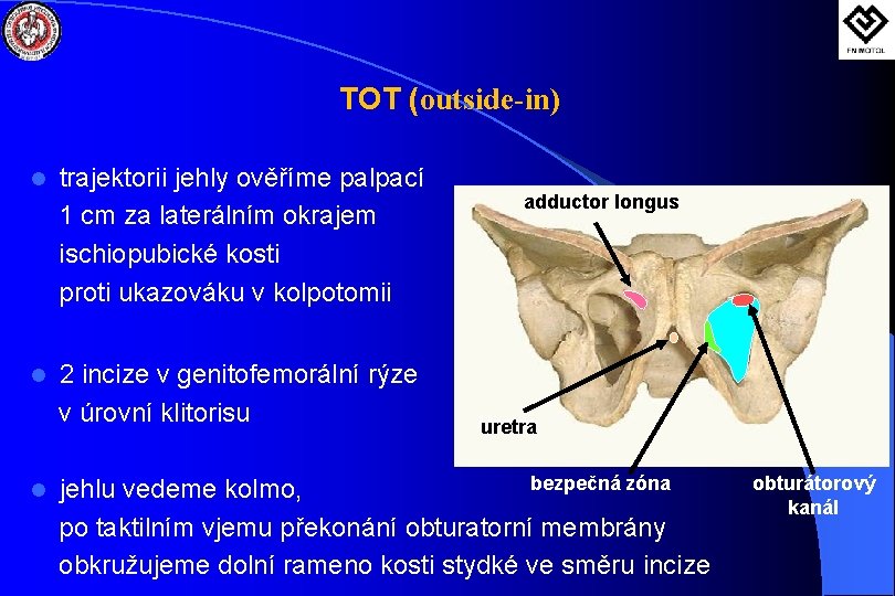 TOT (outside-in) l l l trajektorii jehly ověříme palpací 1 cm za laterálním okrajem