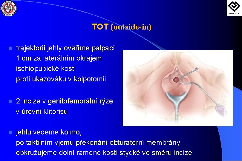 TOT (outside-in) l trajektorii jehly ověříme palpací 1 cm za laterálním okrajem ischiopubické kosti