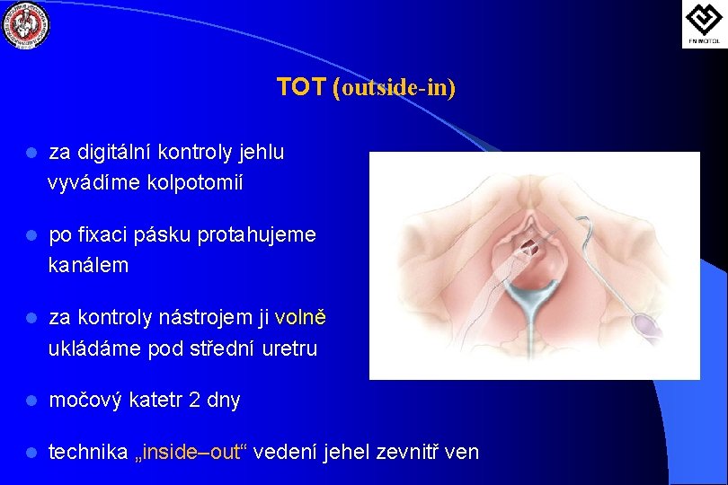 TOT (outside-in) l za digitální kontroly jehlu vyvádíme kolpotomií l po fixaci pásku protahujeme