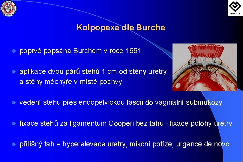 Kolpopexe dle Burche l poprvé popsána Burchem v roce 1961 l aplikace dvou párů