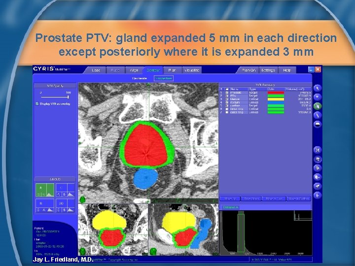 Prostate PTV: gland expanded 5 mm in each direction except posteriorly where it is
