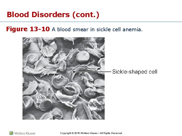 Blood Disorders (cont. ) Figure 13 -10 A blood smear in sickle cell anemia.