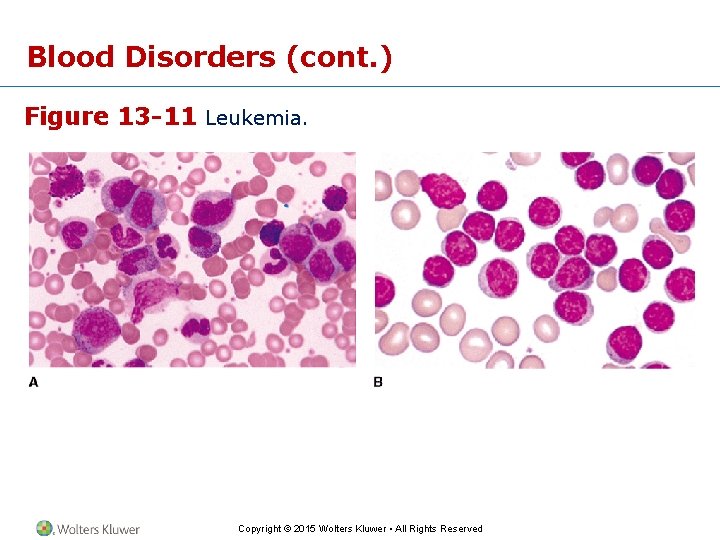 Blood Disorders (cont. ) Figure 13 -11 Leukemia. Copyright © 2015 Wolters Kluwer •