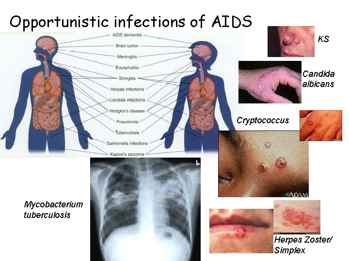 Opportunistic infections of AIDS KS Candida albicans Cryptococcus Mycobacterium tuberculosis Herpes Zoster/ Simplex 