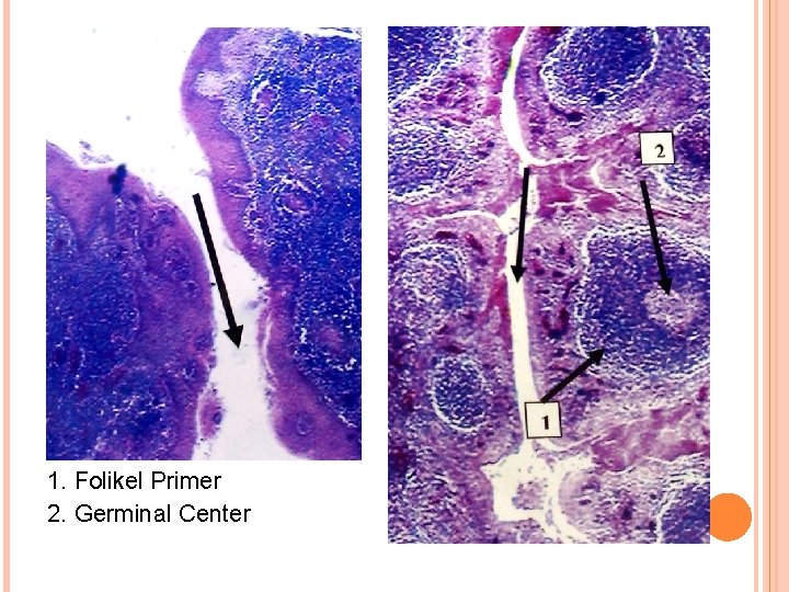 1. Folikel Primer 2. Germinal Center 