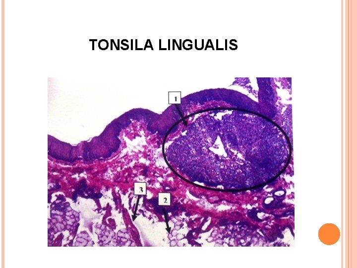 TONSILA LINGUALIS 