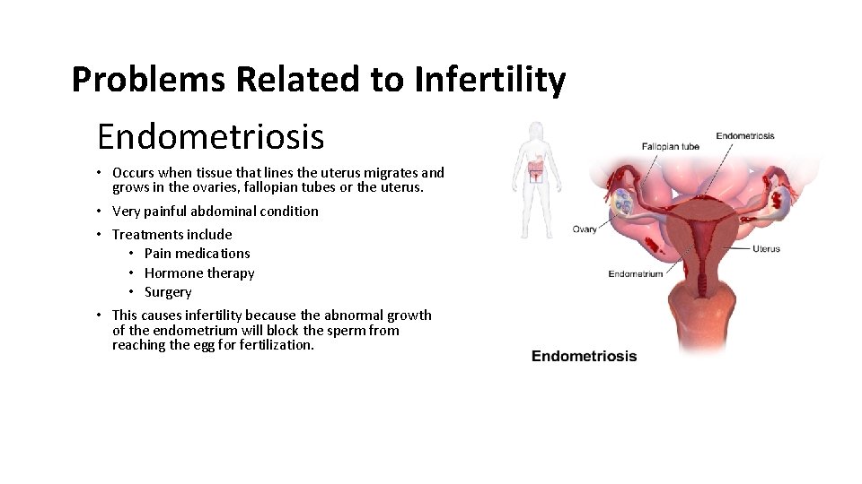Problems Related to Infertility Endometriosis • Occurs when tissue that lines the uterus migrates