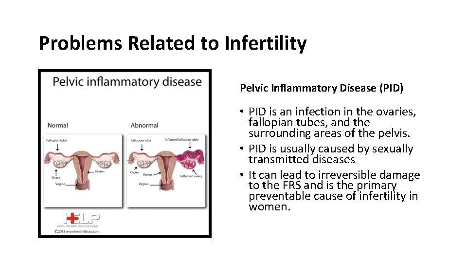 Problems Related to Infertility Pelvic Inflammatory Disease (PID) • PID is an infection in
