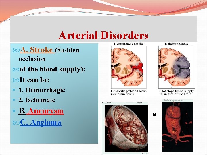 Arterial Disorders A. Stroke (Sudden occlusion of the blood supply): It can be: §