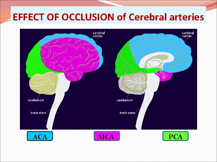 EFFECT OF OCCLUSION of Cerebral arteries ACA MCA PCA 