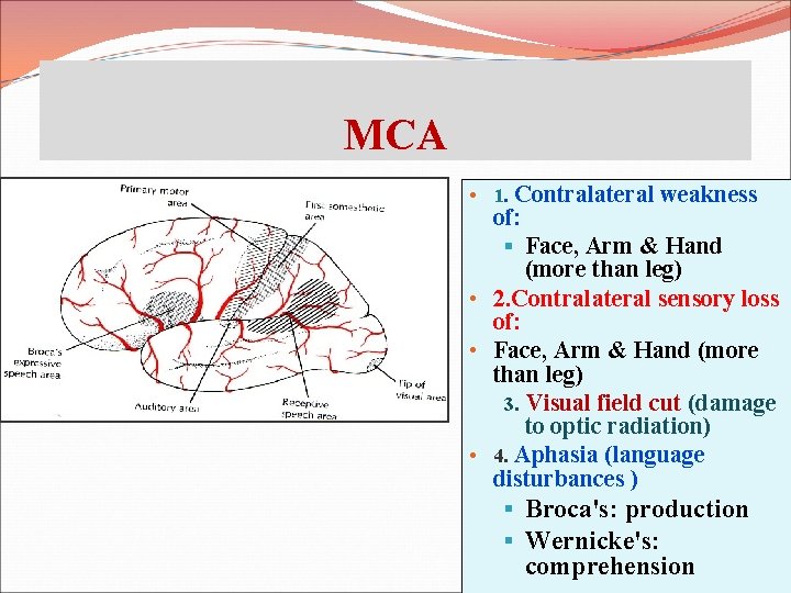 MCA • 1. Contralateral weakness of: § Face, Arm & Hand (more than leg)