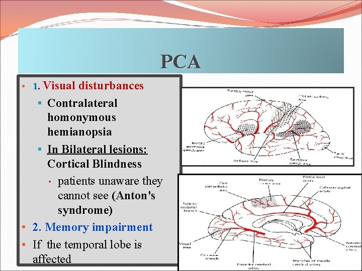 PCA • 1. Visual disturbances § Contralateral homonymous hemianopsia § In Bilateral lesions: Cortical