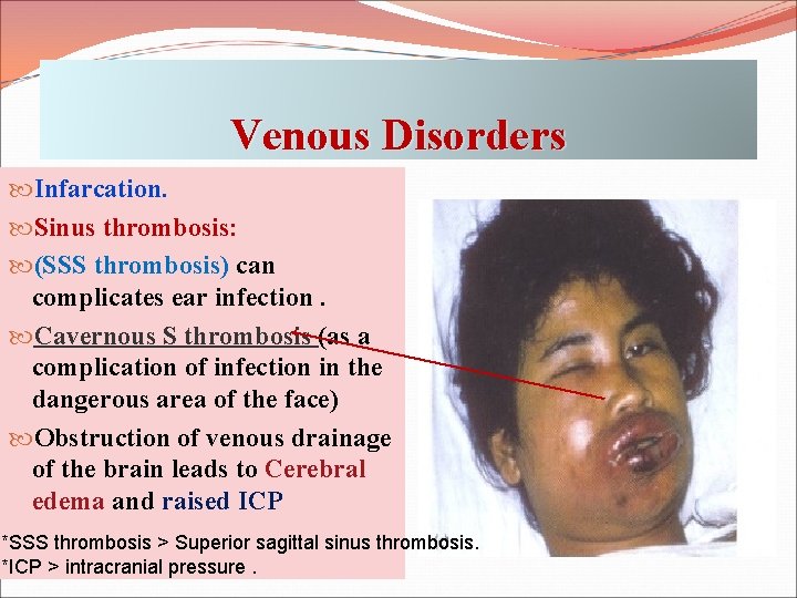 Venous Disorders Infarcation. Sinus thrombosis: (SSS thrombosis) can complicates ear infection. Cavernous S thrombosis