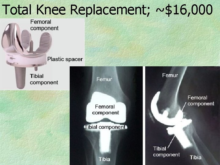 Total Knee Replacement; ~$16, 000 