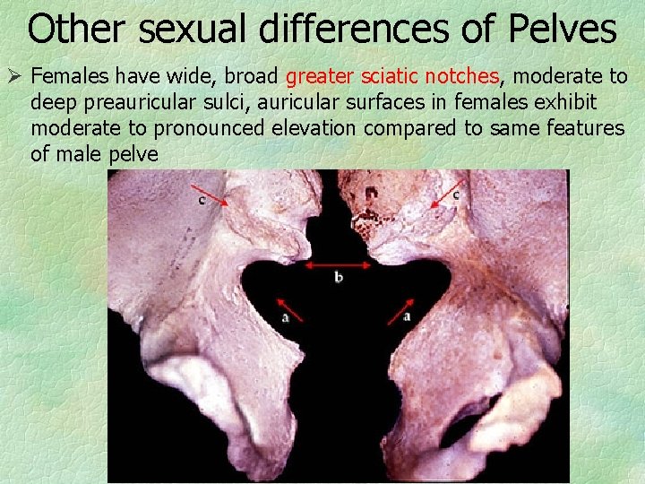 Other sexual differences of Pelves Ø Females have wide, broad greater sciatic notches, moderate