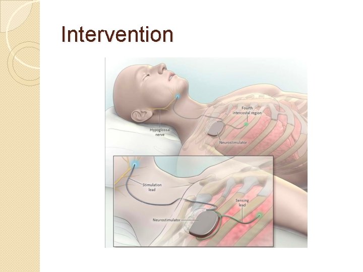 Intervention 