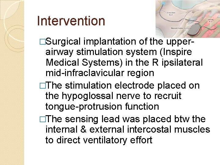 Intervention �Surgical implantation of the upperairway stimulation system (Inspire Medical Systems) in the R