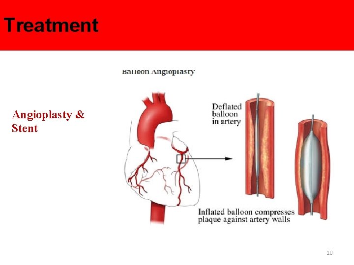 Treatment Angioplasty & Stent 10 