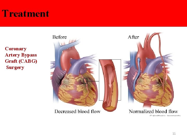 Treatment Coronary Artery Bypass Graft (CABG) Surgery 11 