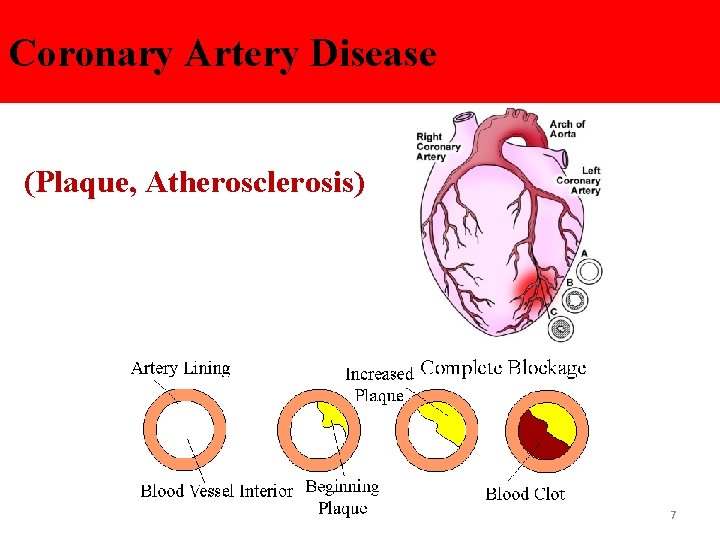 Coronary Artery Disease (Plaque, Atherosclerosis) 7 