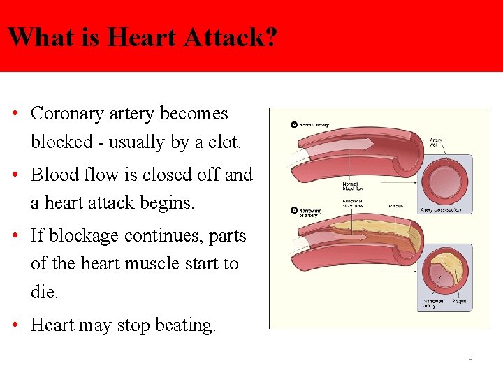 What is Heart Attack? • Coronary artery becomes blocked - usually by a clot.