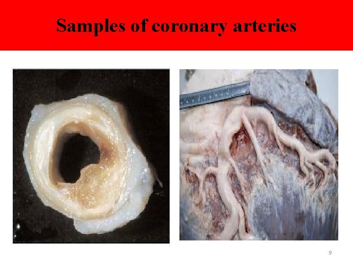 Samples of coronary arteries 9 